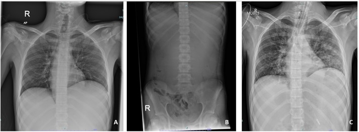 FIGURE 1: (A) Chest radiograph revealed an elevated left hemidiaphragm with absent of gastric bubble; (B) Abdominal radiograph revealed a paucity of small bowel gases that suggest proximal intestinal obstruction; (C) Chest radiograph taken post-intubation revealed bilateral alveolar opacities after the patient aspirated