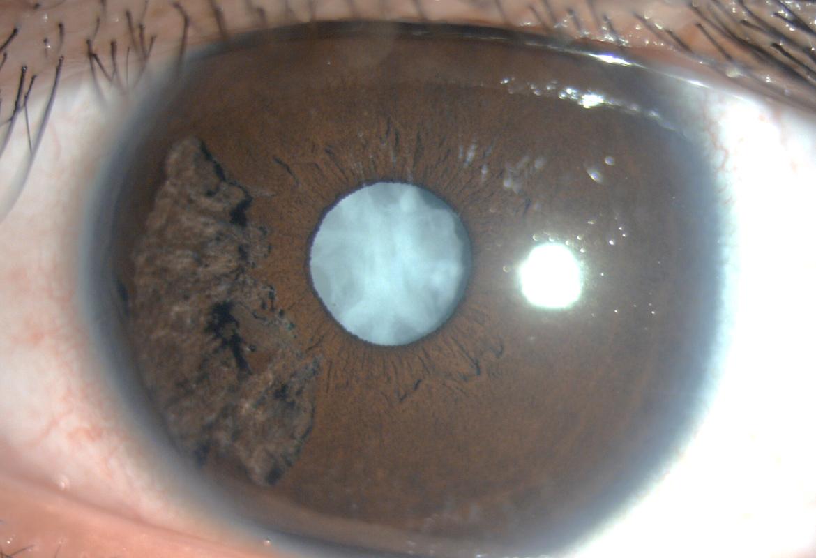 FIGURE 1: Photo of left eye showing sectoral iridoschisis and a dense white cataract