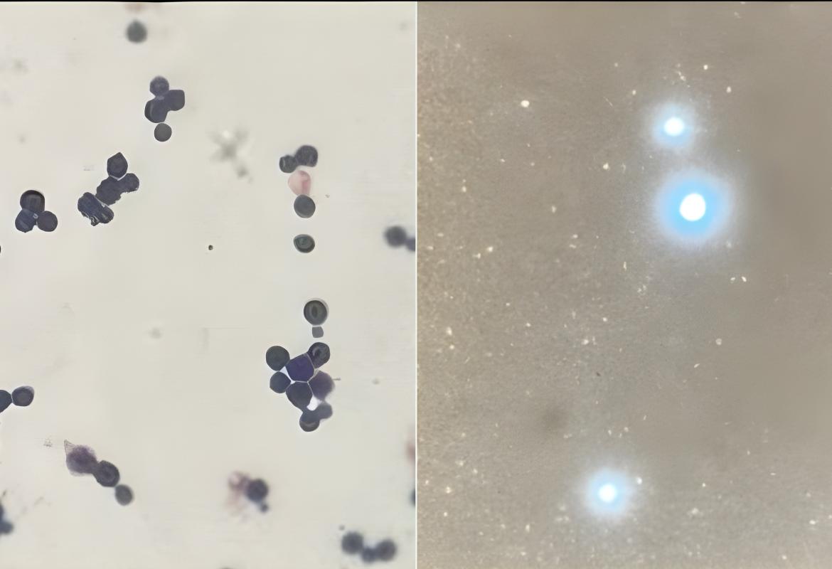 Left: Gram stain showing round yeast cells with budding; Right: India ink preparation positive for encapsulated yeasts