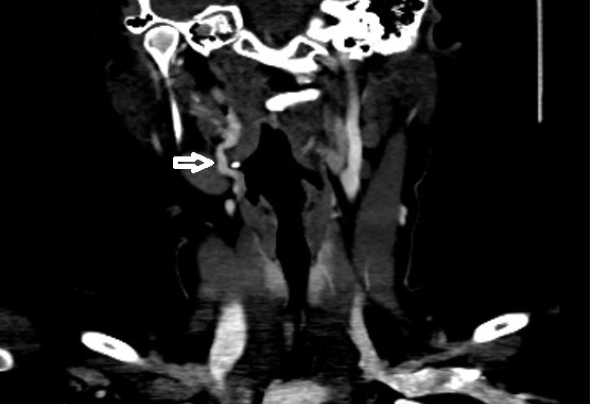 CTA showing tortuosity of right extracranial ICA at level C2 (white arrow)