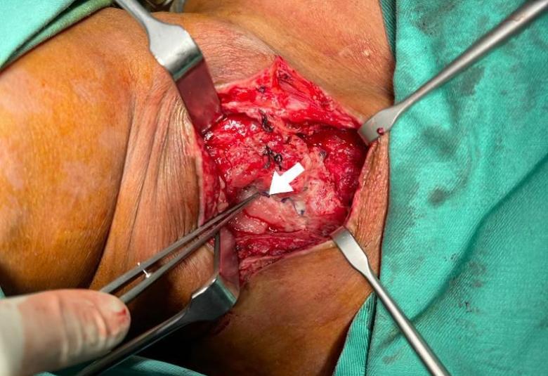 FIGURE 1: Neck re-exploration revealing intact suture at the site of primary repair