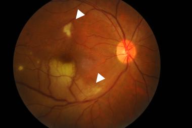 FIGURE 1: Colored fundus photograph of the right eye showed a BRAO involving the inferotemporal arcade (inferior arrow) with surrounding pallid retinal edema associated with an area of focal retinitis (superior arrow)