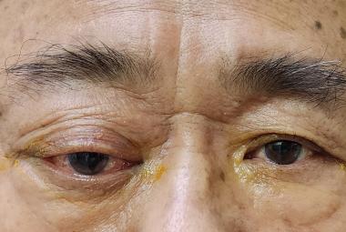Photo of case 1 showed right eye redness, proptosis and temporal scalp swelling