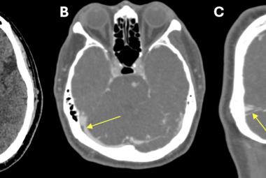 FIGURE 1: (A) Non-contrast CT brain demonstrated acute focal hemorrhage at the right occipital lobe withperihemorrhagic hypodensity extending to the right parieto-occipital region; (B) Subsequent CT venography in axial plane revealed thin linear isodensity within the right transverse sinus; (C) CT venography in coronal plane confirmed the filling defect within the right transverse sinus, consistent with thrombus