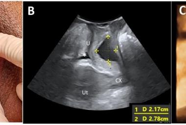 FIGURE 1: (A) A left periurethral mass extending from the left periurethral space to suburethral region measuring 3 cm x 5 cm; (B) Midsagittal view of the pelvic floor showing a cystic mass (*) dorsal to the urethra (U) measuring 2.17 cm x 2.78 cm on translabial perineal ultrasound (TPUS); (C) TPUS view demonstrating a periurethral mass dorsal to the urethra measuring 4.22 cm (width) x 1.99 cm (vertical dimension). (SP: Symphysis pubis; Ut: Uterus; CX: Cervix)