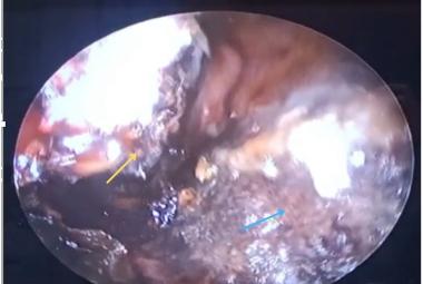 Right nasoendoscopic finding of eschar over the septum (blue arrow) and inferior turbinate (yellow arrow)