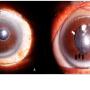 Anterior segment photos showing (A) right eye clear cornea, presence of pseudoexfoliative materials over the pupillary margin, a surgical peripheral iridectomy and a flat conjunctival bleb indicating a failed trabeculectomy, with no sign of vortex keratopathy as compared to (B) whorl-like opacities (white arrows) merging into a horizontal line (black arrows) in the left eye which was very characteristic of vortex keratopathy